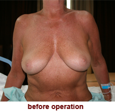 plastic-surgery-breast-lift